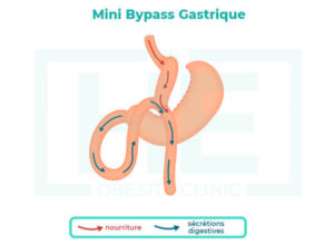 Qu'est-ce qu'un mini bypass gastrique?