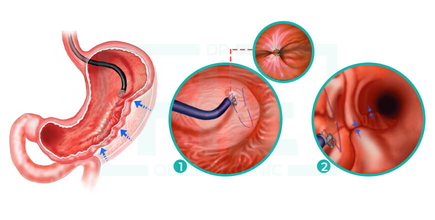 Que es la gastroplastia endoscopica