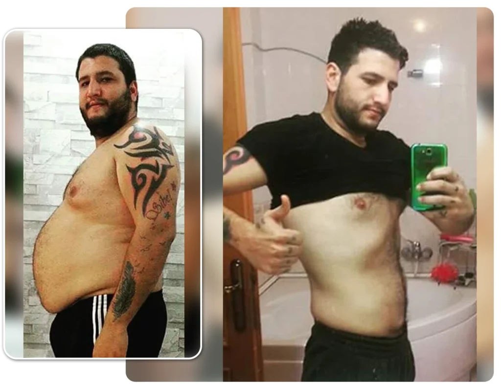 Chirurgie perte de poids: Avis Sleeve Gastrique Lucas M.