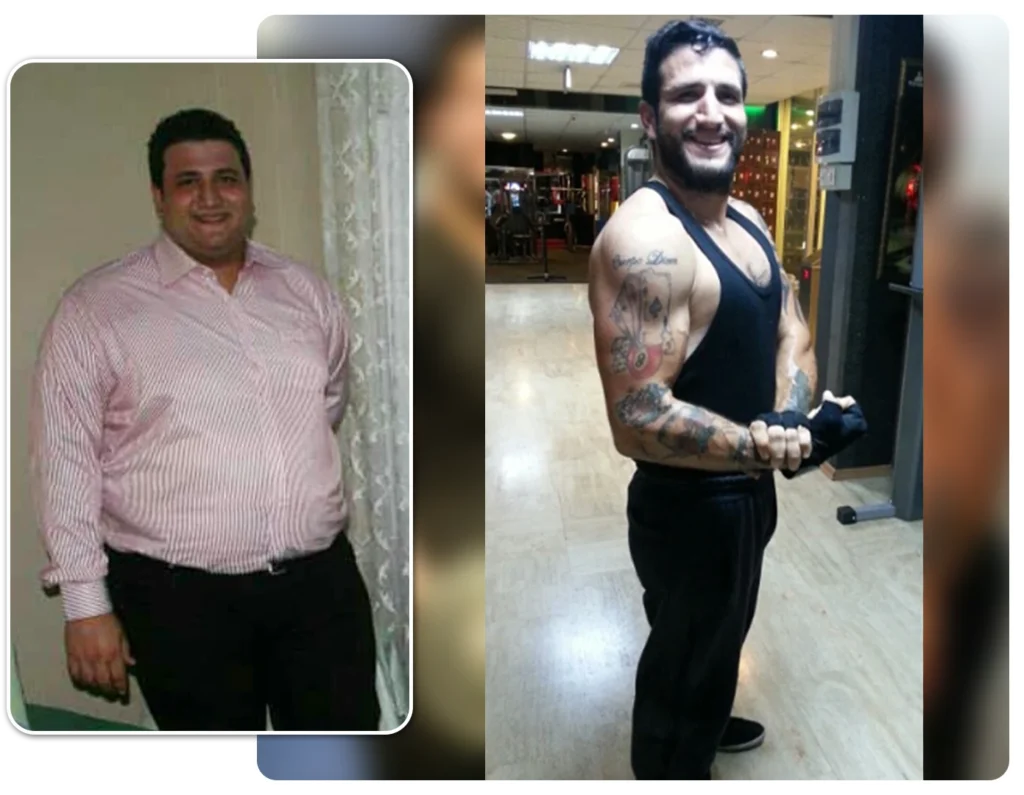 Chirurgie perte de poids: Avis Sleeve Gastrique Lucas M.