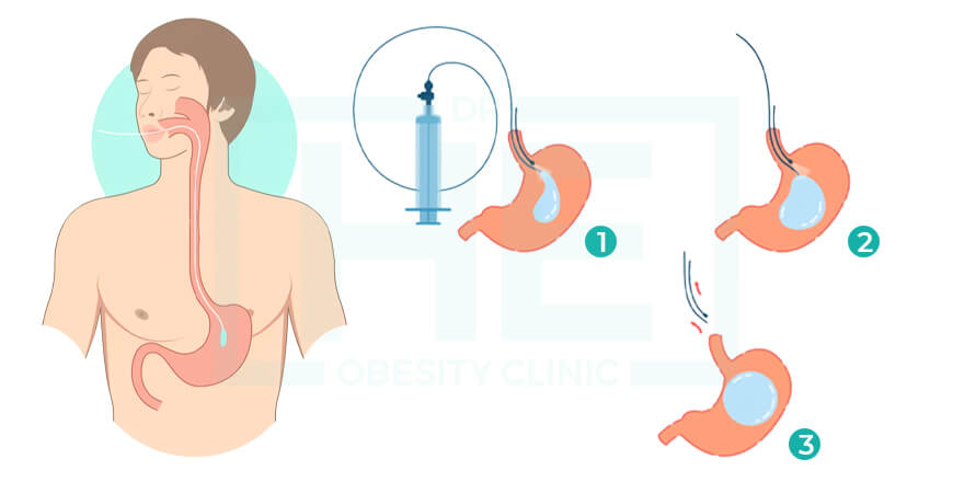 Balón Gástrico en Turquía Precio