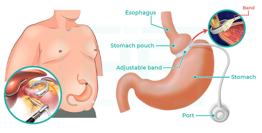 Gastric Band Surgery in Turkey Price