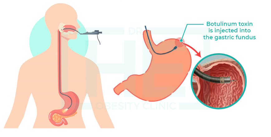 Gastric Botox in Turkey Price