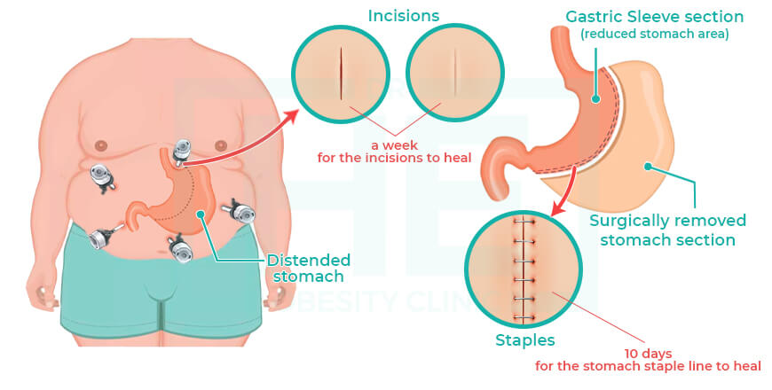 Gastric Sleeve Surgery in Turkey