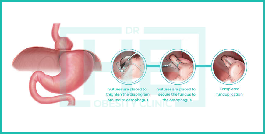 How-Nissen-Fundoplication-Surgery-Turkey