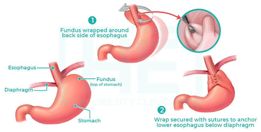 How-Nissen-Fundoplication-Surgery