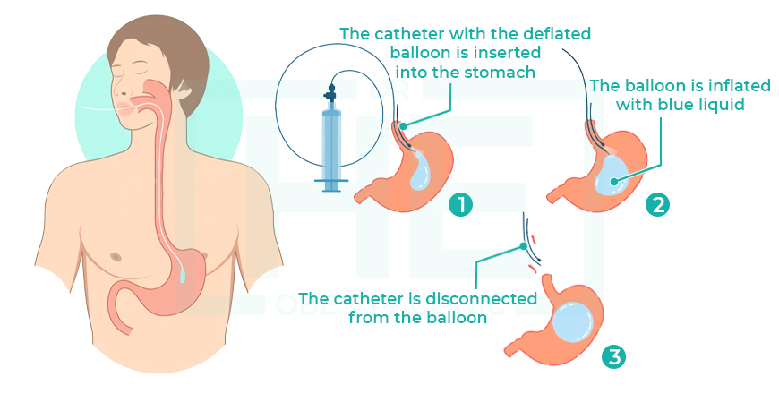 Gastric Balloon Turkey