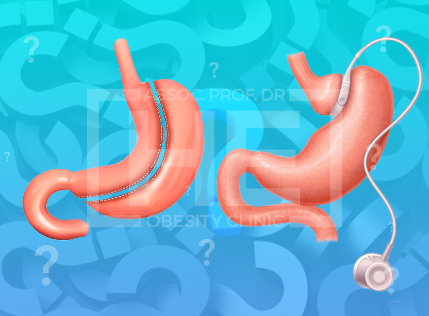 ¿Que diferencias hay entre la banda gástrica y la Manga Gástrica?