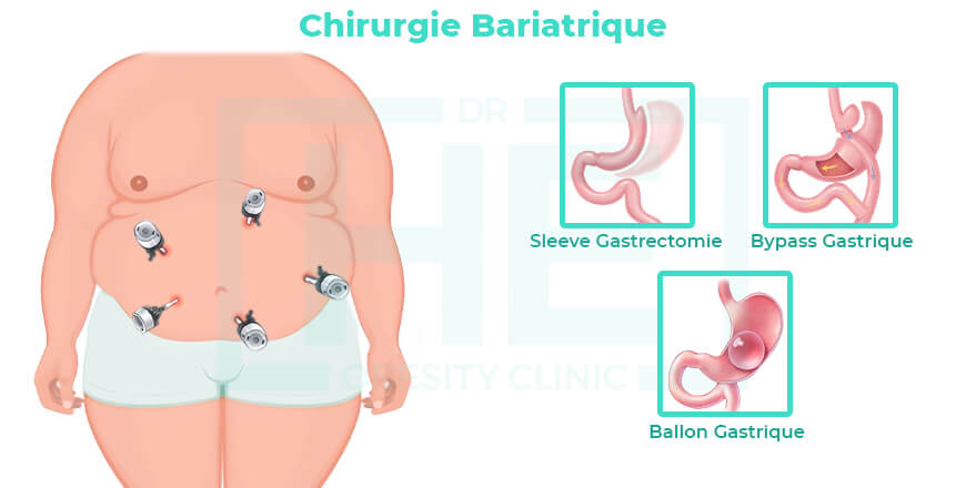 Chirurgie Bariatrique Turquie