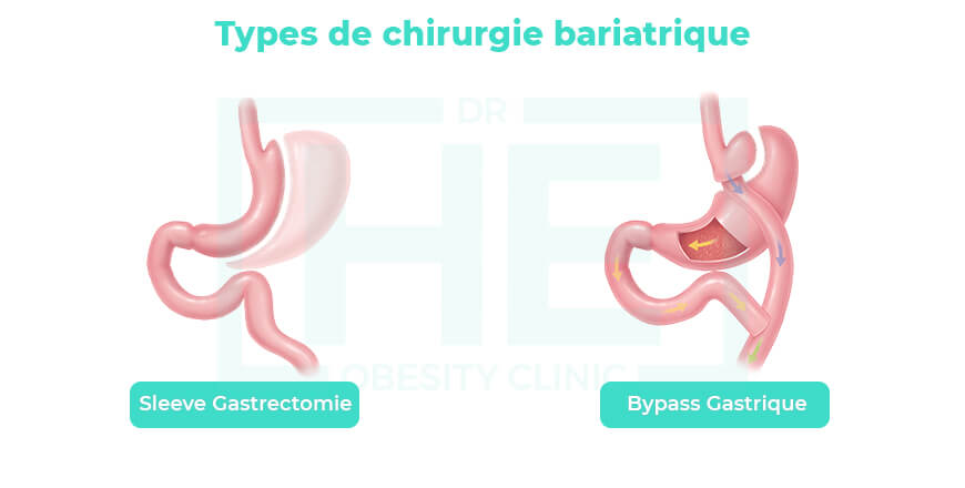 Chirurgie Bariatrique Turquie